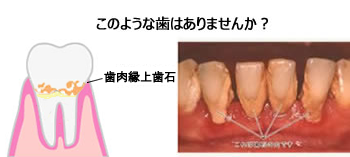 歯肉の上の歯石、歯肉縁上歯石