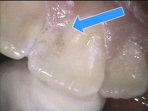 虫歯の前歯