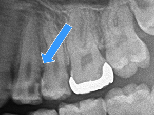 虫歯の前歯