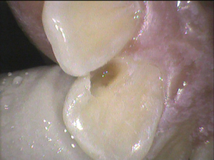 歯の内部の虫歯