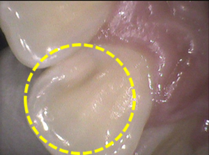 歯の内部の虫歯