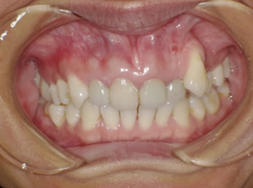銀歯を全部外しセラミックとCR充填にて修復しました。