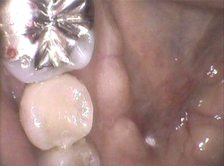 虫歯の部分をキレイにとって『セレック』というセラミックを入れました。