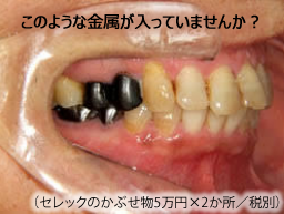 歯科金属アレルギー