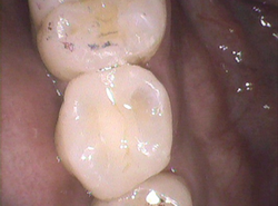 穴も痛みもない歯の中にある大きなむし歯を除去、神経も残せました！