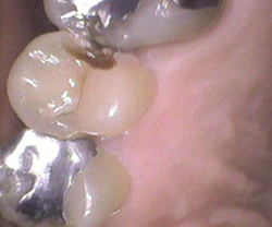 歯の中のむし歯を除去、削る量を最小限にして処置することができました！