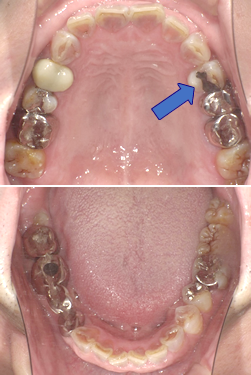 歯科金属アレルギーの可能性があり来院され、お口の中の金属の詰め物かぶせ物を外しました。