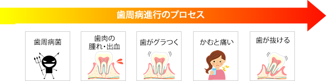 歯周病進行のプロセス