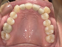 銀歯を全部外しセラミックとCR充填にて修復しました。