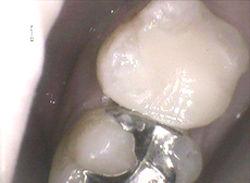 中で虫歯になっていたので虫歯を除去した後、『セレック』というセラミックインレーを入れました。