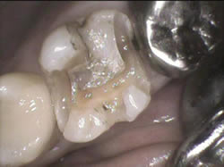 銀歯を外すと大きな虫歯はなかったですが、溶け出していて全体に虫歯になっていました。