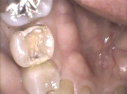 銀歯を外すと中で虫歯になっていました。
