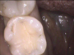 歯科金属アレルギー症状のある方で、金属を外してコンポジットレジンに置き換えて、経過観察しておりました。症状が軽快されて、コンポジットレジンもスリ減りが大きくなってきたので、セラミックに換えます。